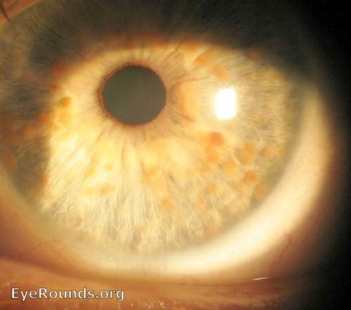 全身肿瘤怎么治疗,浑身长满肿瘤怎么办