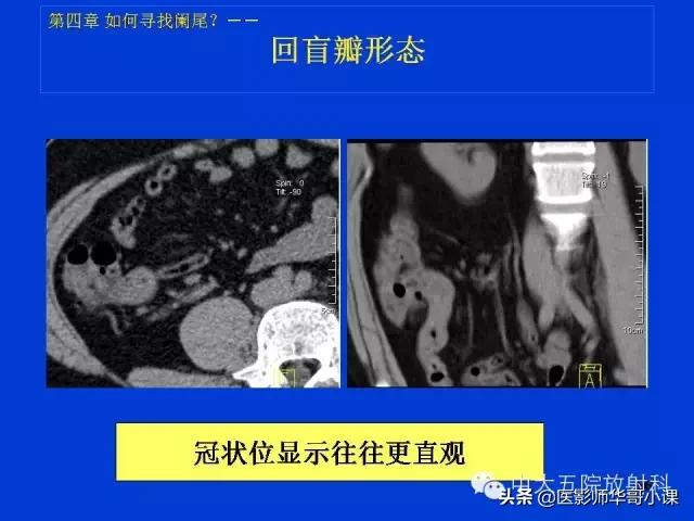 阑尾炎课件,阑尾炎的超声课件