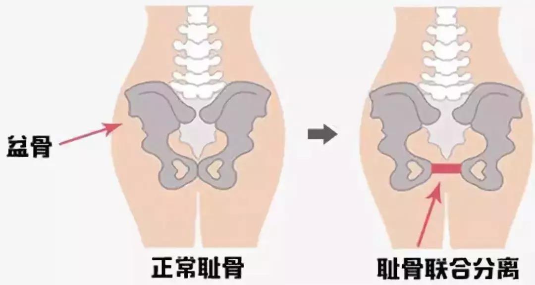 ella产后漏尿怎么办,ella产后尿失禁案例