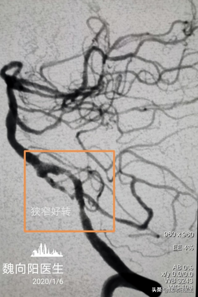 放入支架腰疼怎么办,支架后头晕怎么回事