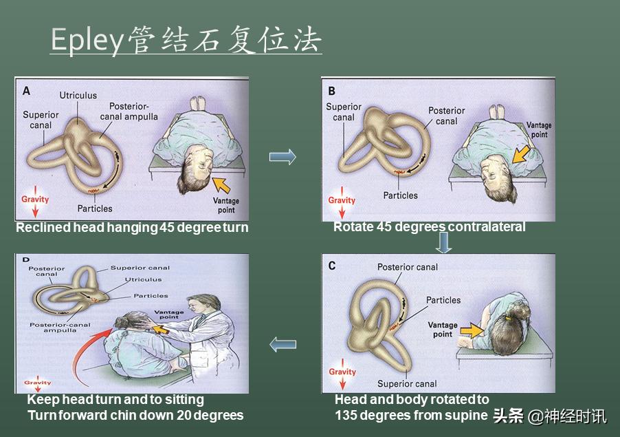 良性位置性眩晕诊断和治疗指南,良性阵发性位置性眩晕的诊断标准