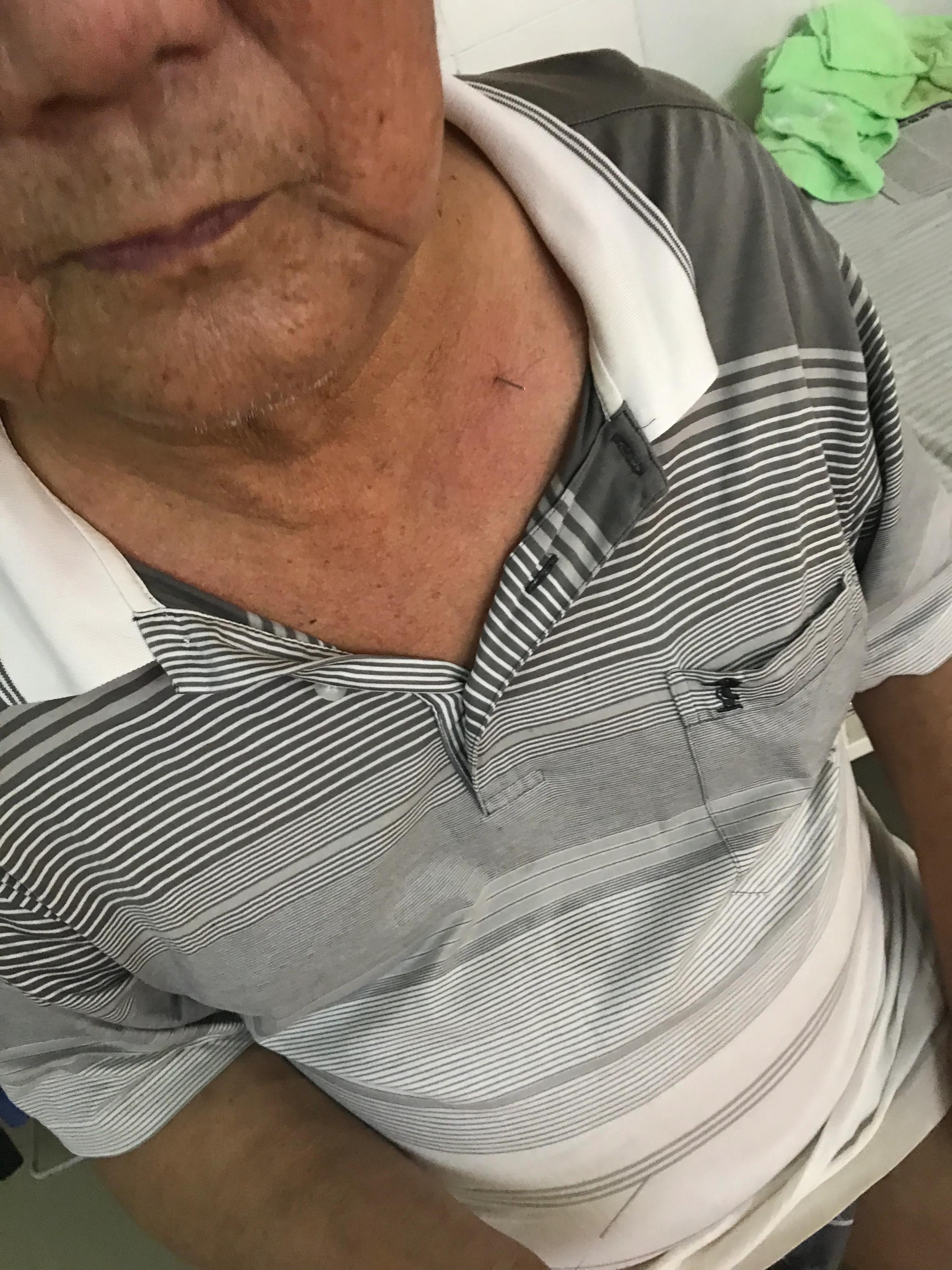 古派巨灵针灸治疗足跟痛实战分享