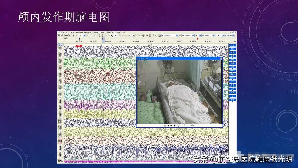 张光明左颞叶癫痫手术成功率,张光明谈治疗癫痫的方法有哪些