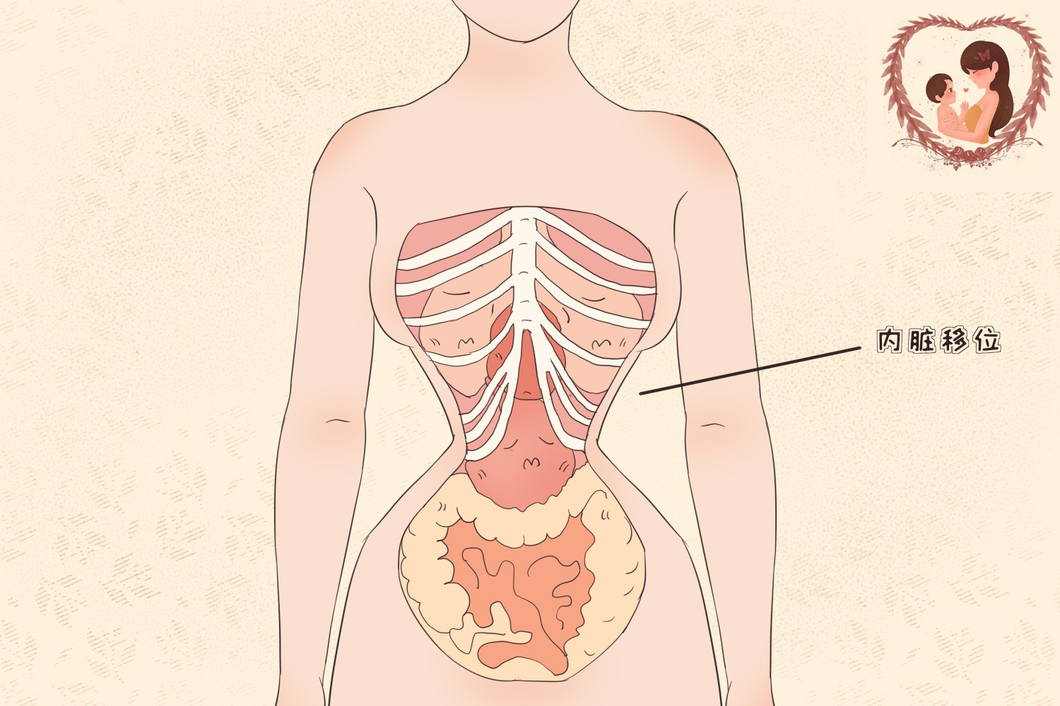 束腹带是瘦肚子神器？别轻信商家的宣传，用不对可能导致子宫脱垂