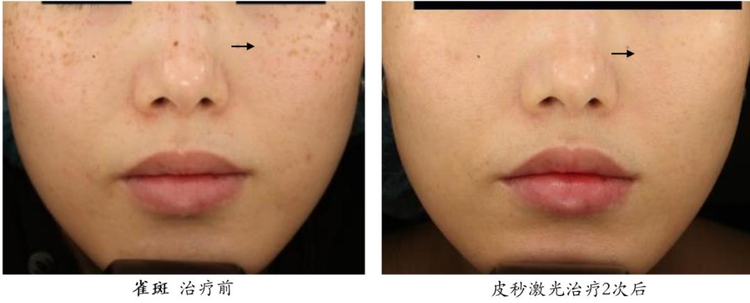 皮秒激光伤皮肤吗,皮秒激光能治凹陷疤痕吗