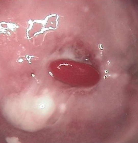 宫颈老是觉得有异物是怎么回事,宫颈长菜花状异物是癌症吗