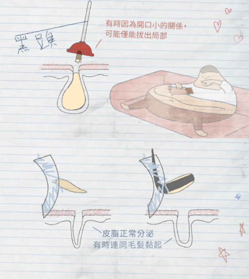 去除黑头最简单最有效的方法,去除黑头既简单又有效的方法