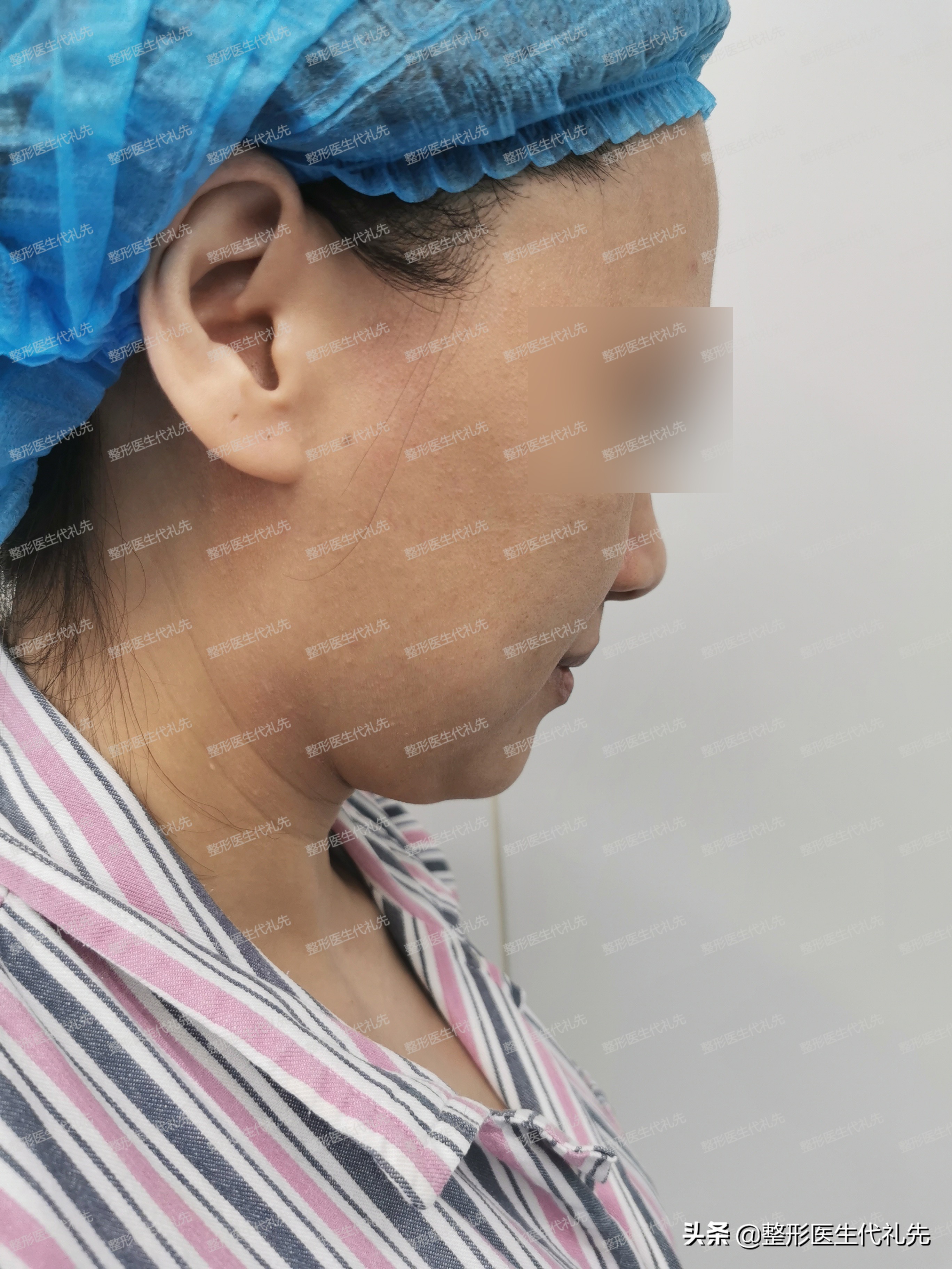 做微创过程,超微创小切口面部提升维持多久