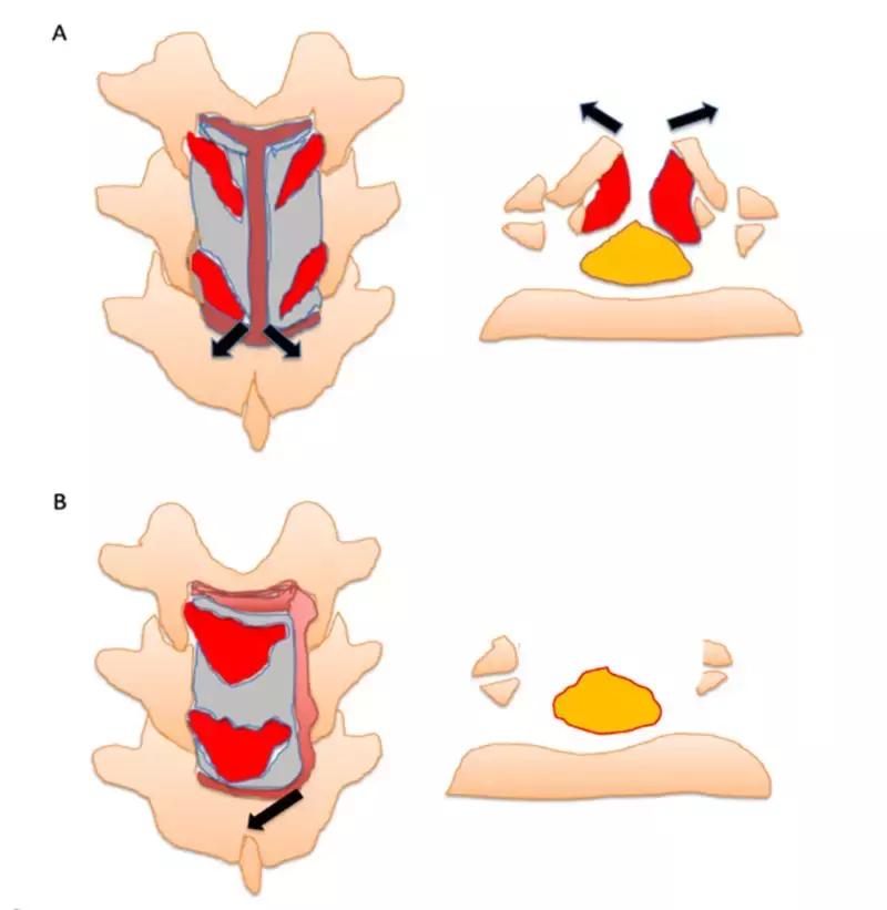 胸椎黄韧带骨化的治疗方法,胸椎黄韧带骨化症手术效果如何