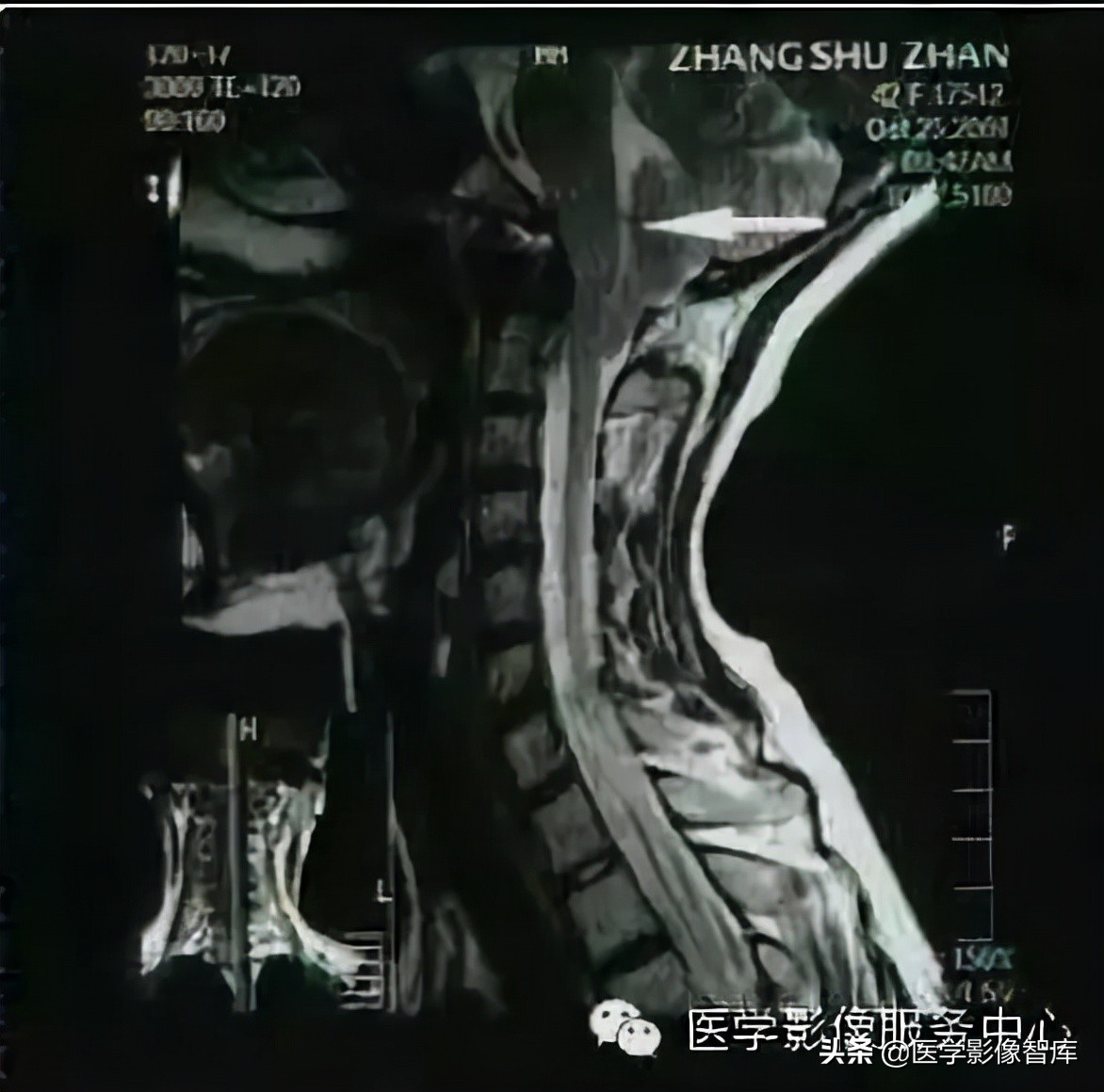 chiari畸形确诊,chiari畸形症状会一直有吗