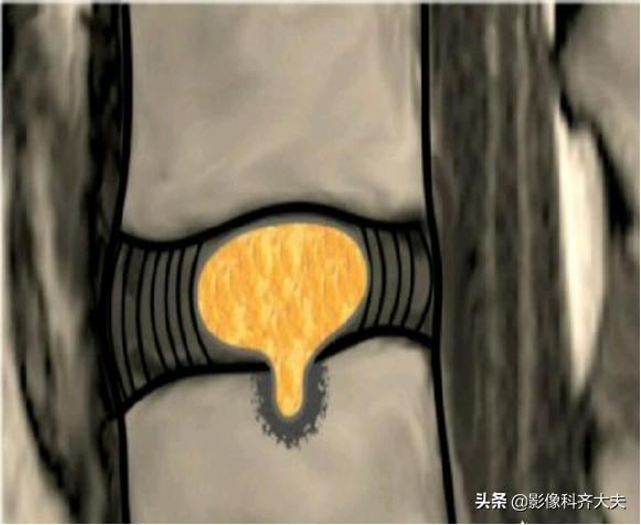 腰椎间盘突出最好的影像诊断方法,腰椎间盘突出的影像学检查