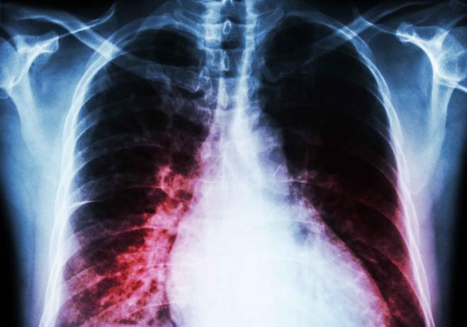 为何确诊肺炎，但白细胞却并不高？赶紧来了解一下