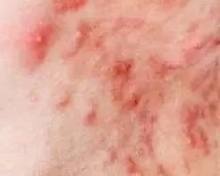 后背痘痘的成因及治疗