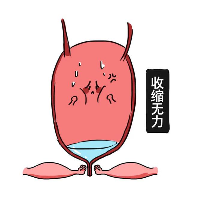 睡觉尿憋回去是怎么回事,憋回去的尿最终会从哪里排出来