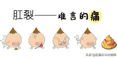 治疗肛裂最有效的小妙招,治疗肛裂的小妙招免费好用