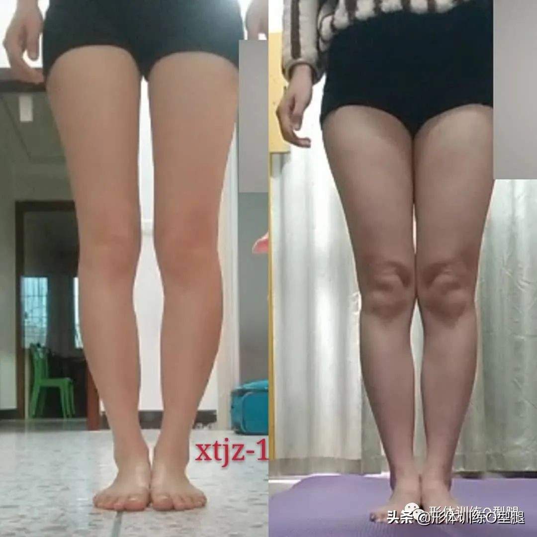 o型腿和罗圈腿图片对比,o型腿和罗圈腿的区别