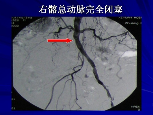 腿疼血管堵塞是怎么回事,腿疼血管堵