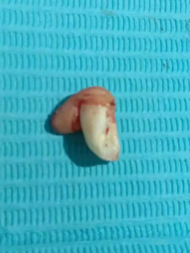 郑州牙齿矫正蔡留意教授：儿童七岁前，牙不疼不用见牙医？