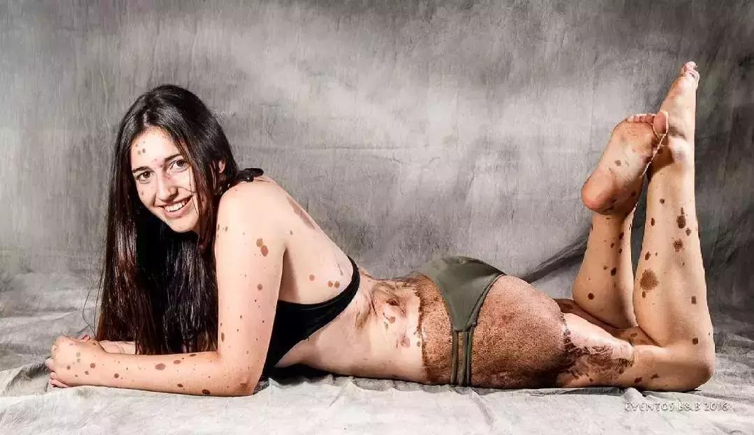 全身黑斑被骂“斑点狗”，身高160的她却成为最美超模…