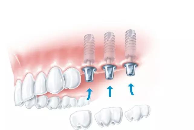 2023年口腔种植发展曲线图,目前口腔种植体种类