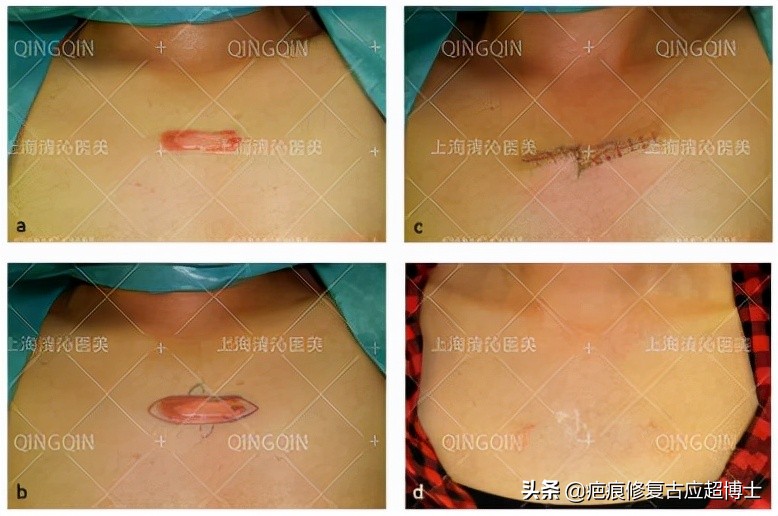 不忘初心，深耕疤痕难题！（匠心筑梦烙印天使）