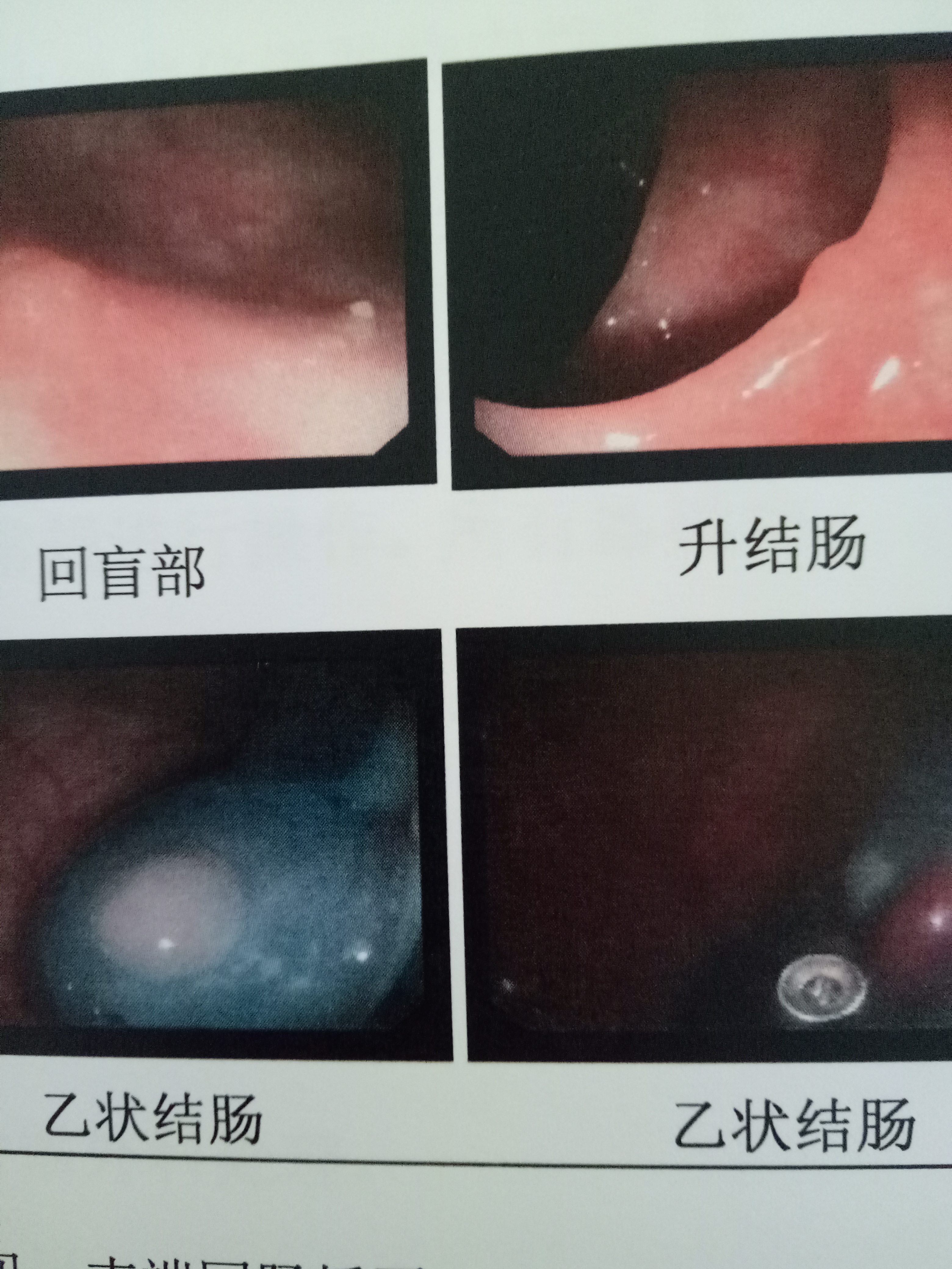 肠息肉发展为肠癌大约多久,肠息肉到肠癌要经过几个阶段