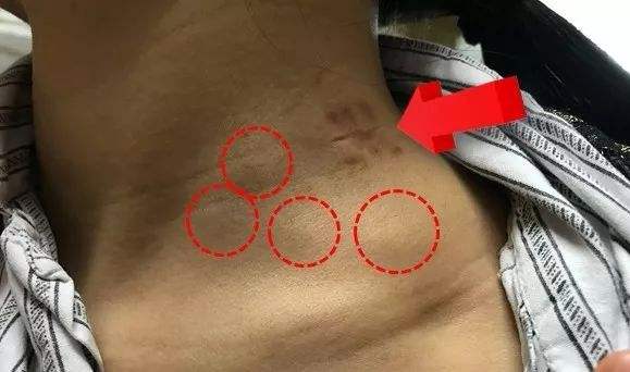 淋巴肿大脓没排干净怎么处理,淋巴疏通排毒究竟是何方骗术