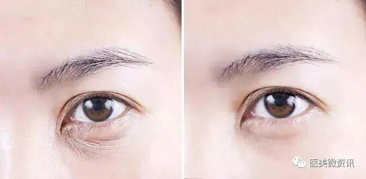 眼周除皱的最佳方法,眼周祛皱术后效果对比