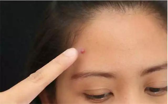 眨眼睛面部肌肉跟着动是什么原因,面部三叉神经痛是什么原因造成的