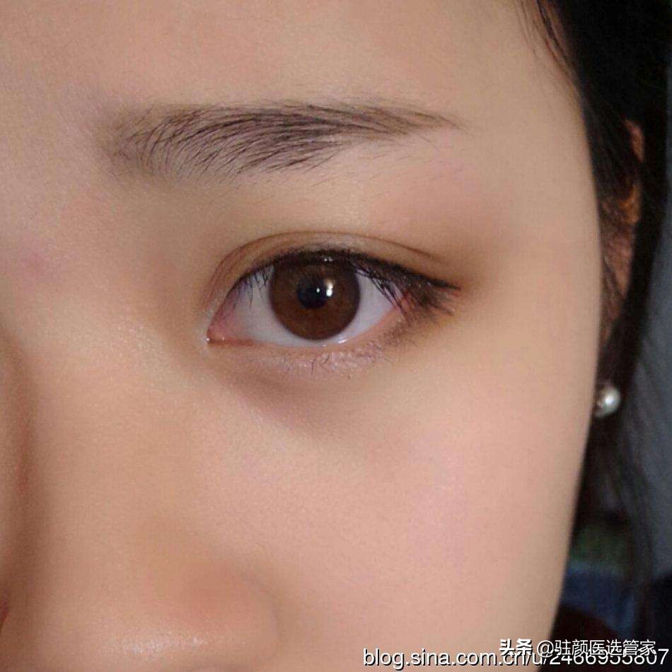 十个关于双眼皮的真相,关于双眼皮有哪些误区