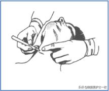 干货：气管切开术及护理措施