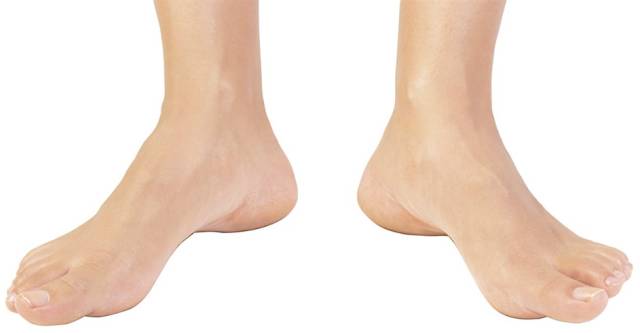 跑步时脚是外八字怎么纠正,膝盖内扣脚外八字跑步