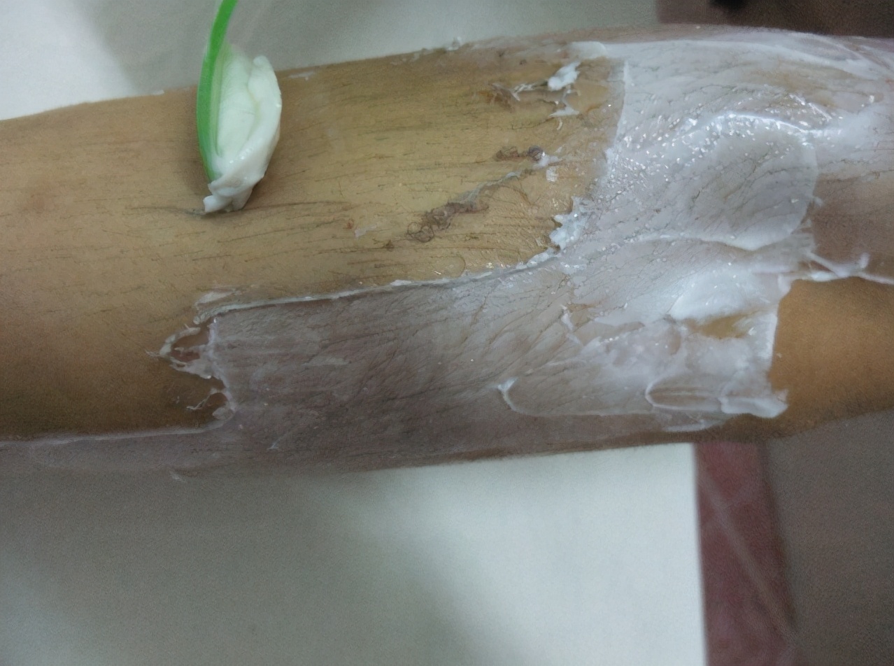 哪种毛适合激光脱毛,最近的激光脱毛