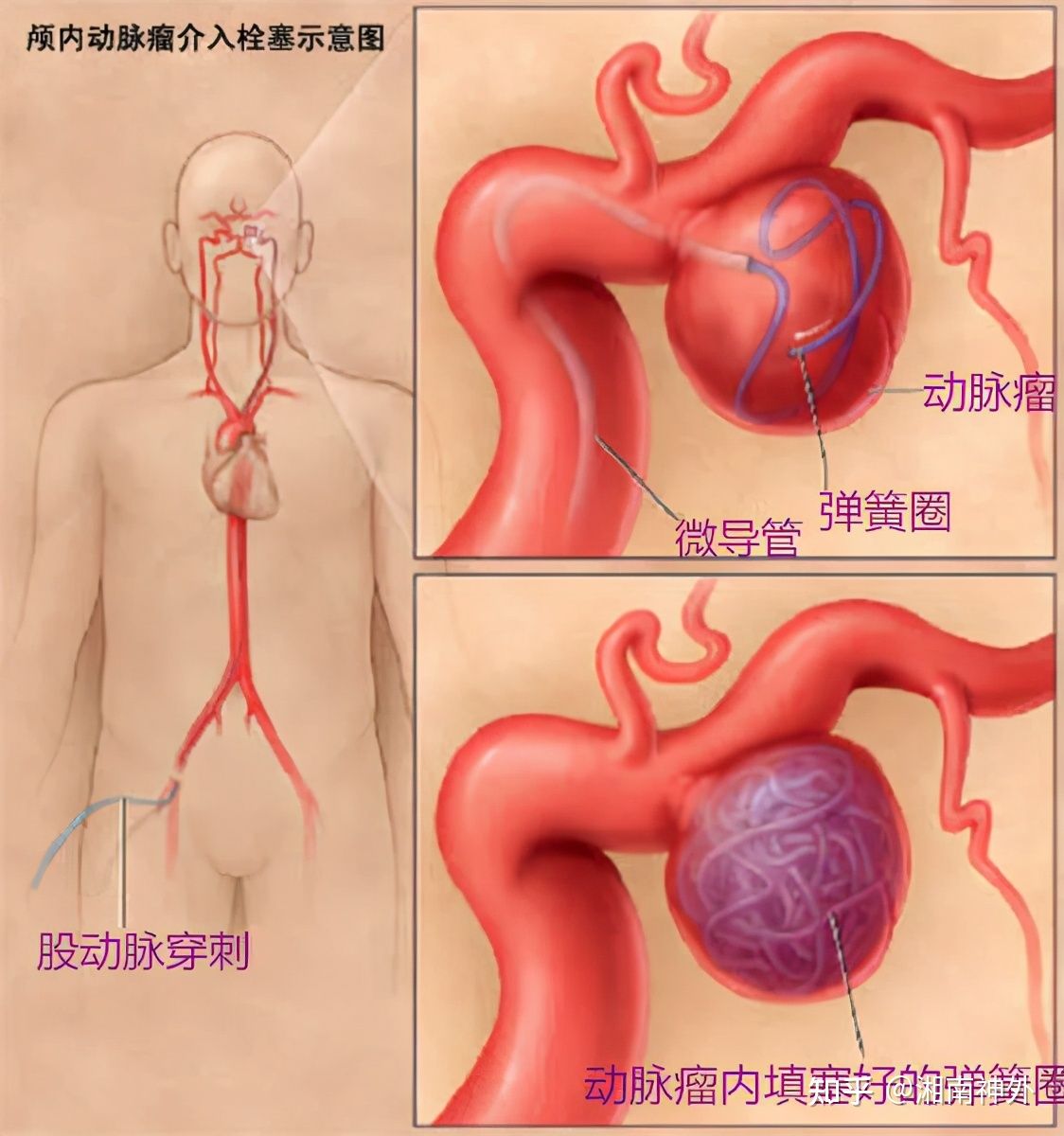 脑动脉瘤的定时炸弹,颅内定时炸弹