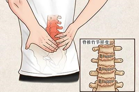 强直脚后跟疼有什么办法缓解,强直引起髋关节疼痛怎么缓解