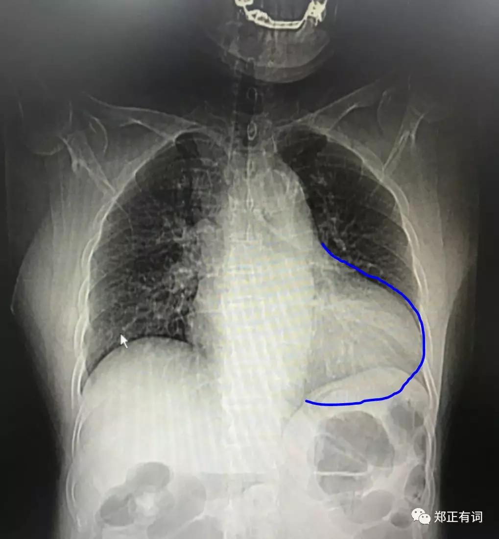 心肺功能特别差能动肺手术吗,肺癌想做手术呼吸功能差怎么办