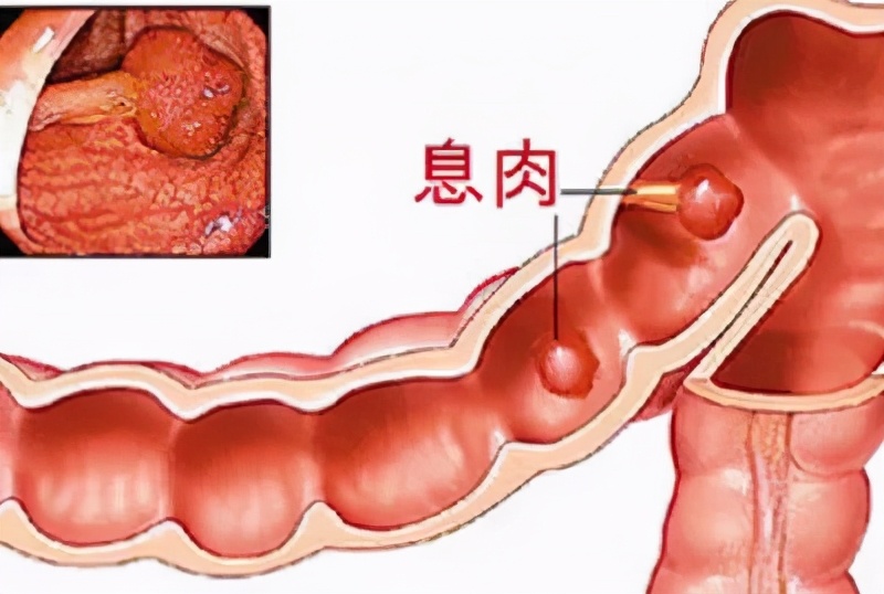 治疗息肉结节中医药方,息肉结节一定要手术吗
