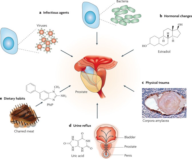 慢性无菌性前列腺炎会传染妻子吗,女性会传染给男性前列腺炎吗