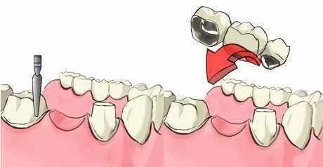 单颗牙缺失搭桥牢固吗,单颗槽牙缺失修复选用哪种方法好