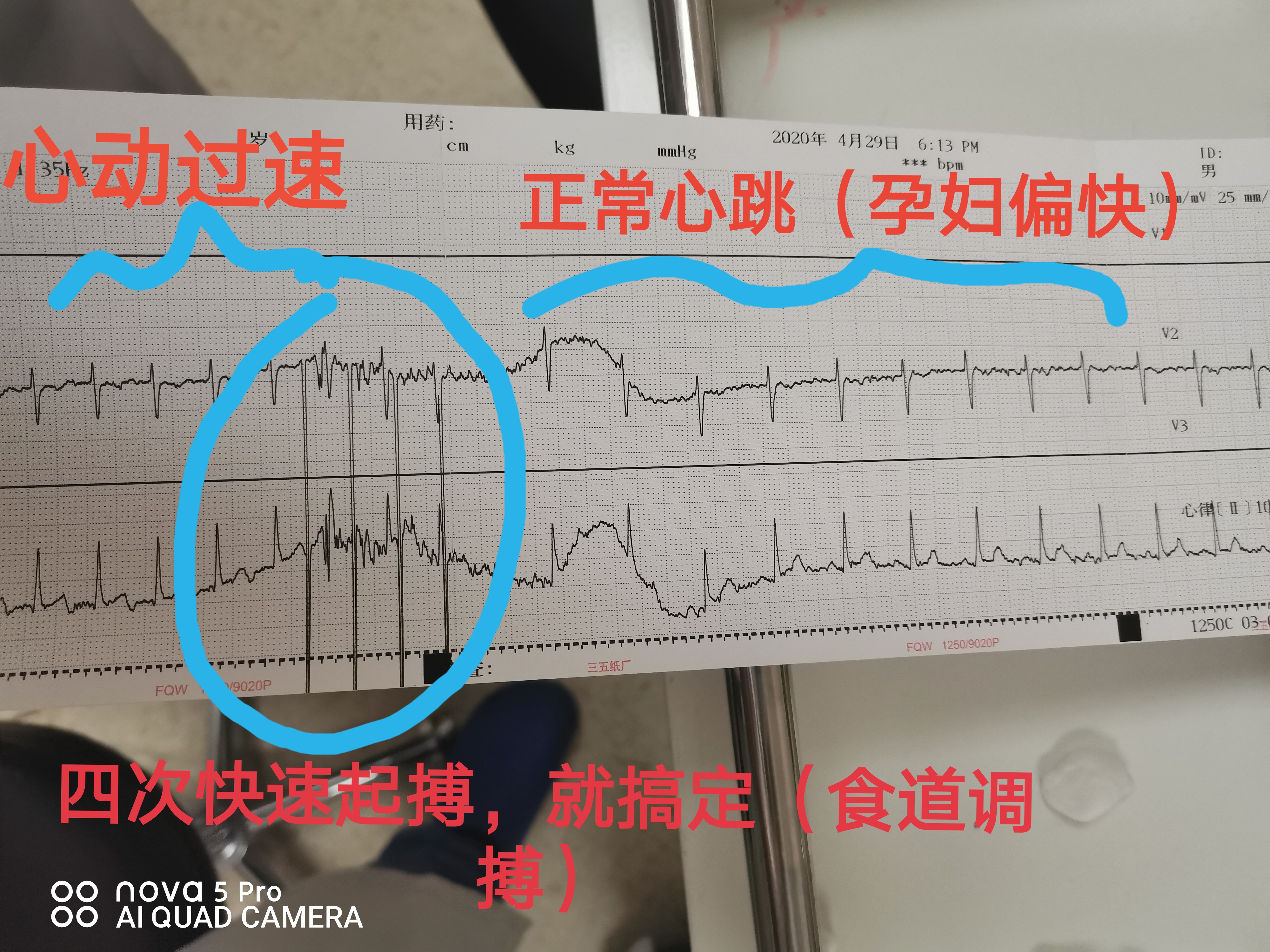 孕妇25周心动过速怎么办,孕28周孕妈心动过速