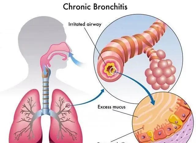 中医老慢支治疗最佳方法,老慢支感冒吃什么药