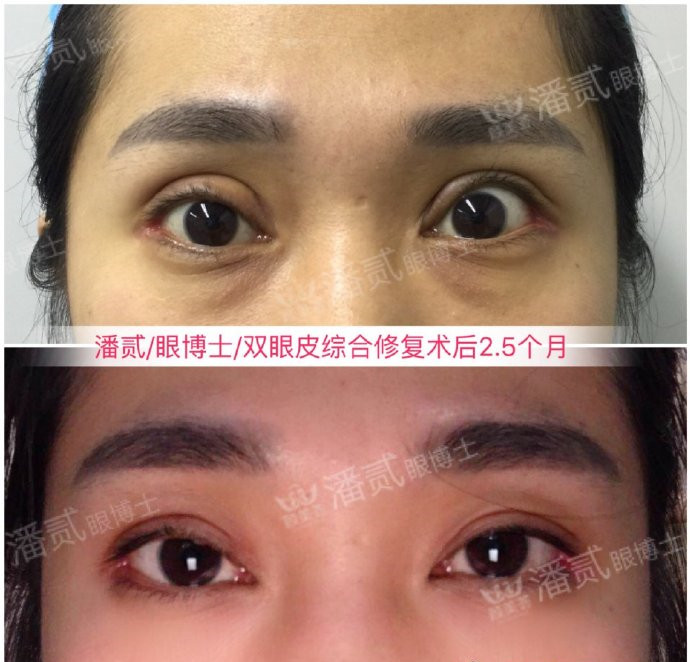 我想做个双眼皮,上睑下垂做了提肌双眼皮