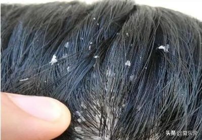 去除头皮屑去屑最好的方法,去头皮屑最好的方法不用洗发水