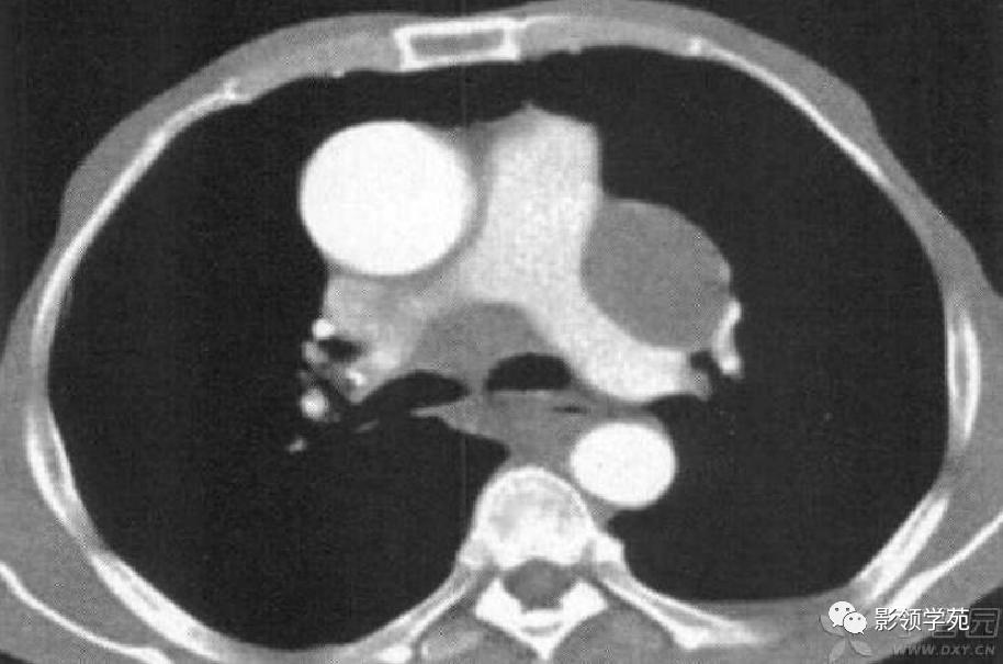 肺肉芽肿影像学表现ppt,肺韦格纳肉芽肿影像学表现