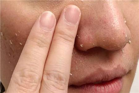 去黑头完了如何修复,去黑头省钱攻略