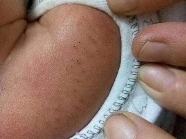 猪毛风婴儿,新生儿身上有猪毛风是怎么来的