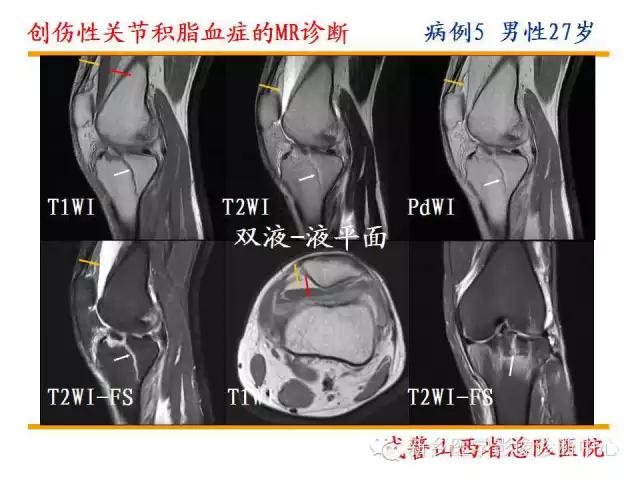 膝关节炎髌上囊积液自己看得出吗,髌上囊有积液膝盖会走路无力吗