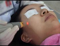 激光美容有哪些项目,激光美容都有哪些项目