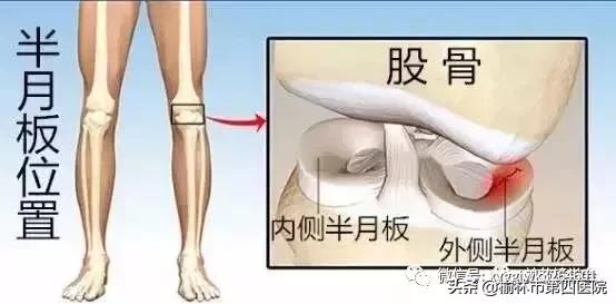 内侧半月板后角损伤怎么治疗,半月板损伤有积液的最好治疗