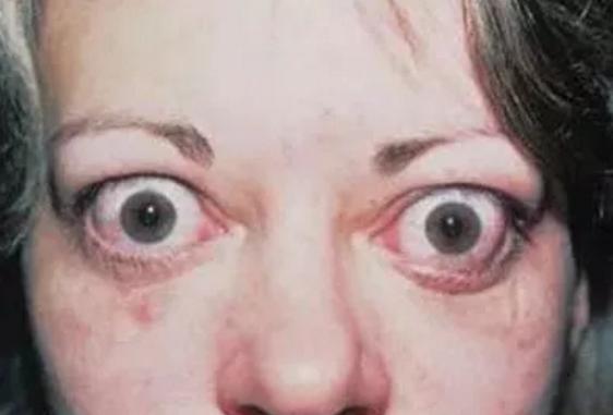 甲亢突眼怎么缓解,甲亢突眼什么原因